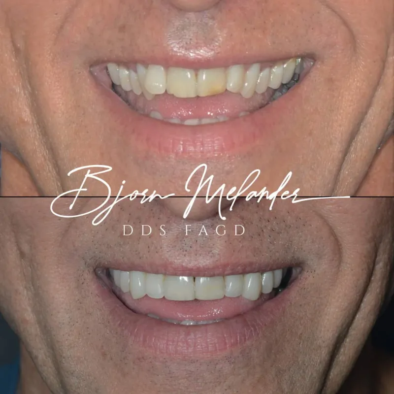 Before and after smile transformation by Dr. Bjorn Melander